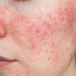 “DAMAGE SKIN BARRIER”